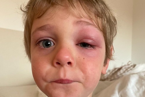 When Allergy Symptoms Mask a Serious Eye Condition