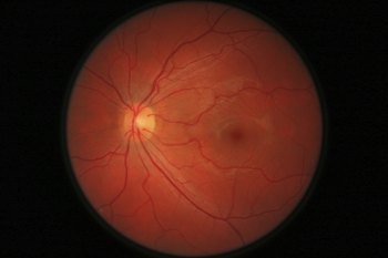 Macular Degeneration - Can I Lower My Risk?