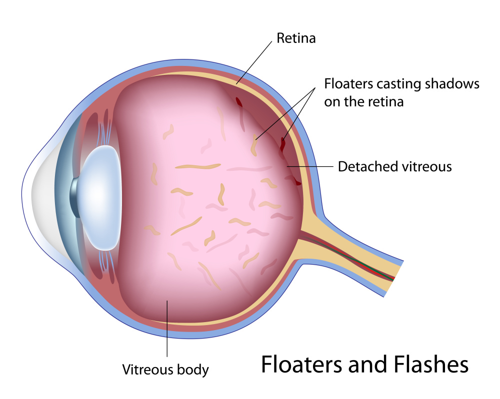 What are eye floaters?