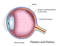 What are eye floaters?