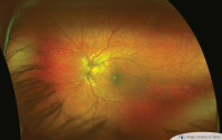 Optos Optomap®